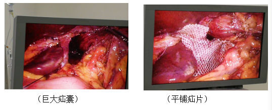 外一科成功开展一例腹腔镜巨大食管裂孔疝修补术